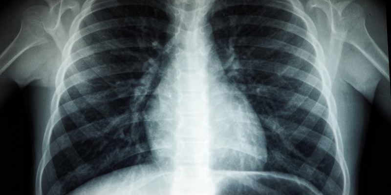 New Discoveries in Radiotherapy | Assistance for Cancer Pati